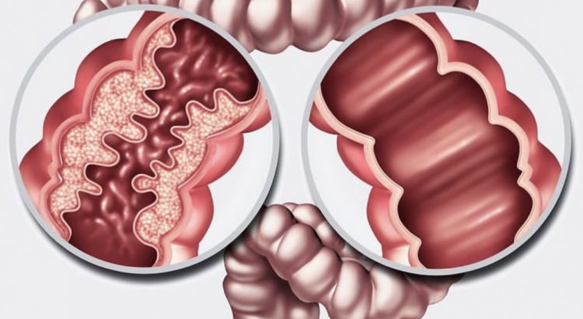 Crohn Hastalığının Teşhisi