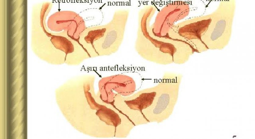 Antefleksiyon nedir?